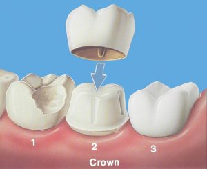 We are the best in dental crowns in Hornsby.